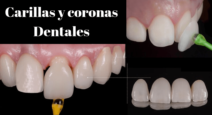 Carillas y coronas dentales: ¿en qué se diferencian y para qué sirven?