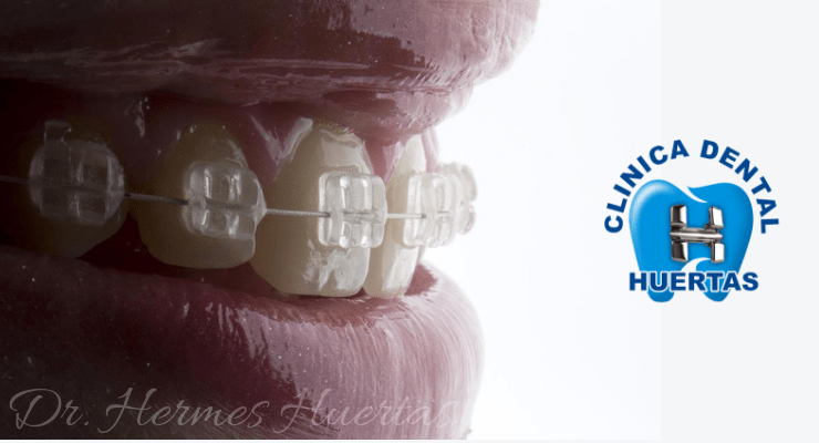 Ortodoncia Brackets Cómo Funcionan
