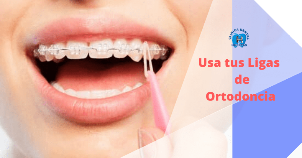 Uso de elásticos en un proceso de ortodoncia